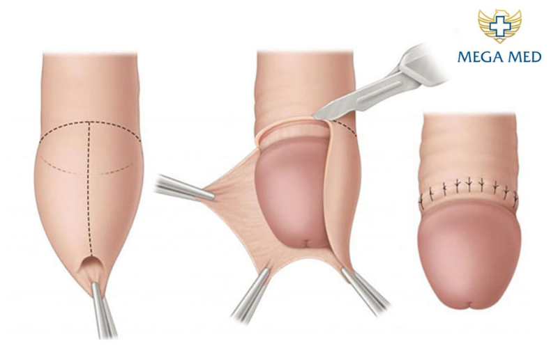 Phương pháp cắt bao quy đầu truyền thống